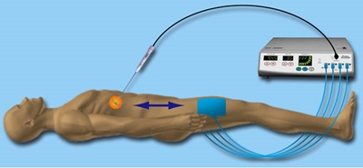 Radiofrequency Ablation หนึ่งในวิธีการรักษามะเร็งตับ